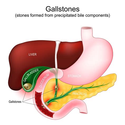 What is Gallbladder Surgery? - GBL Hospital