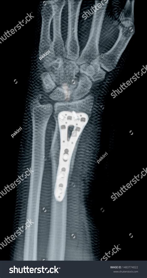 X Ray Fracture Hand Bones Stock Photo 1483774022 | Shutterstock