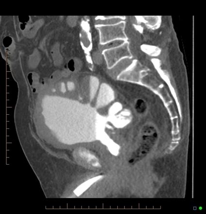 Urinary bladder diverticulum | Radiology Reference Article | Radiopaedia.org