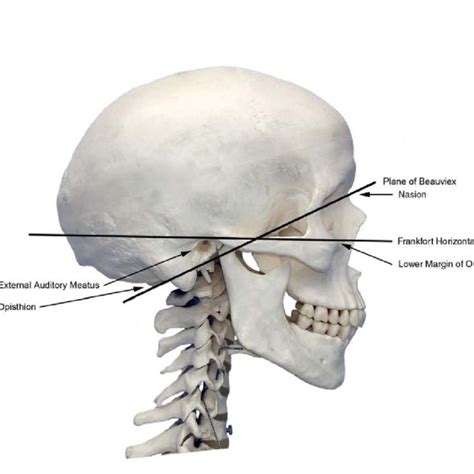 Frankfort Plane Dental Definition - DEFINITION HJO