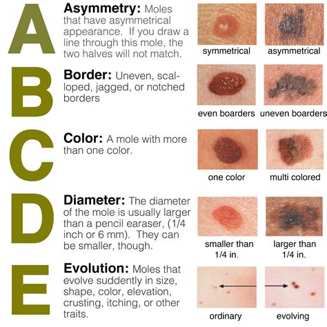May is Skin Cancer Awareness Month: Skin Cancer is an Equal Opportunity Disease