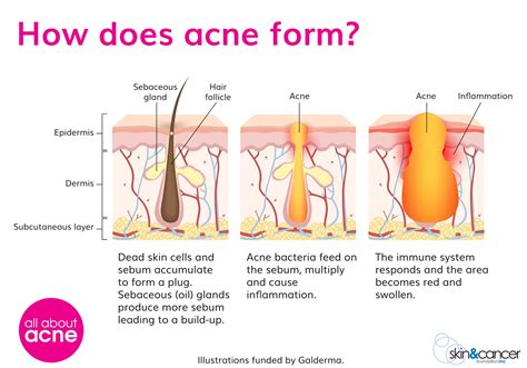 What Causes Acne - Acne Causes - All About Acne