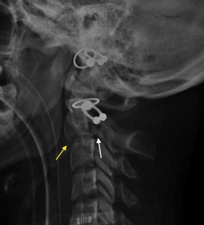 Hangman fracture - Radiology at St. Vincent's University Hospital