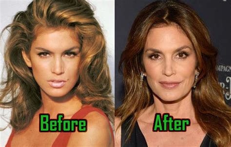 Cindy Crawford: Plastic Surgery Is Her Beauty Secret! Before-After! | CelebritySurgeryIcon