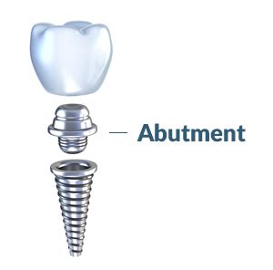 Elk Grove Custom Dental Implant Abutment | Sacramento