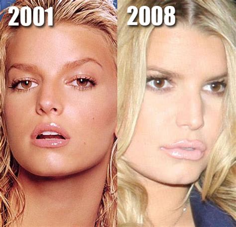 Jessica Simpson Plastic Surgery Before and After Lips and Collage Injection | Plastic Surgery