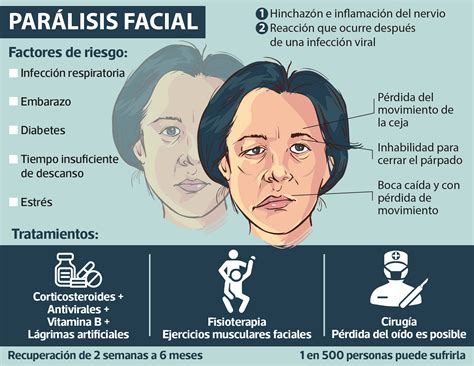 Parálisis facial: causas, síntomas y tratamiento con fisioterapia