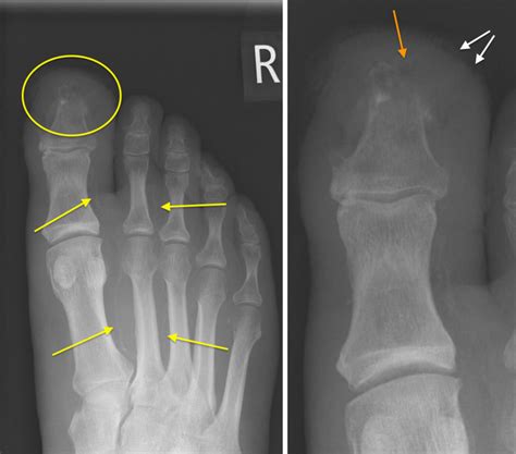 Diabetic foot - osteomyelitis - Radiology at St. Vincent's University ...