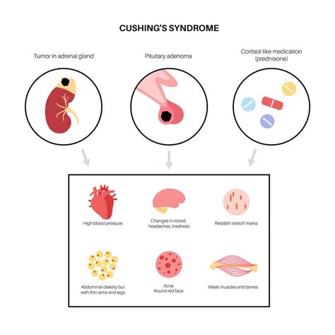 What is Cushing’s syndrome? Explaining Amy Schumer’s diagnosis