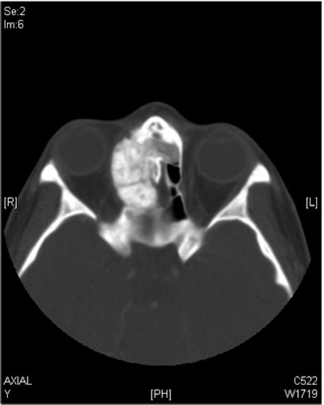 Paranasal axial CT scan shows right ethmoid sinus and nasal cavity mass ...