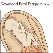 Sacrococcygeal teratoma | CS Mott Children's Hospital | Michigan Medicine