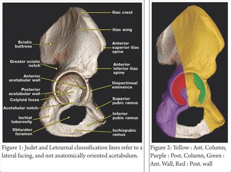 Understanding Clinical Radiology of Fracture Acetabulum – Trauma ...