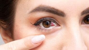 Boric acid eye wash for conjunctivitis: Is it a safe treatment? | HealthShots