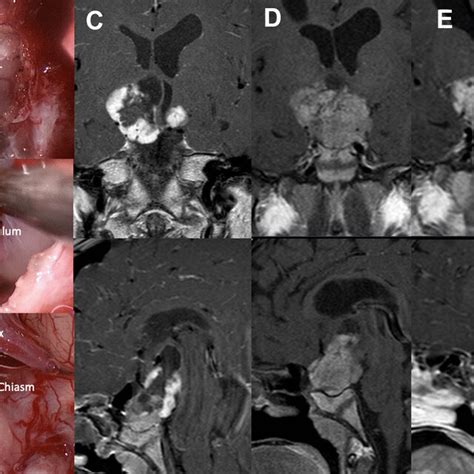 Case of combined approach. A Preoperative coronal-sagittal MRI. B Optic... | Download Scientific ...