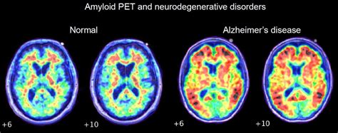 Pet Scan Brain Dementia