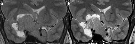 Treatment effect of cabergoline on giant prolactinoma. Coronal T2 MRI.... | Download Scientific ...