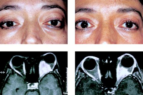 Stereotactic irradiation of biopsy proved optic nerve sheath meningioma | British Journal of ...