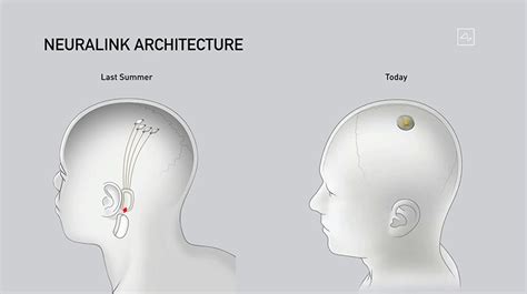 elon musk's neuralink unveils brain implant update and the surgical robot to insert it