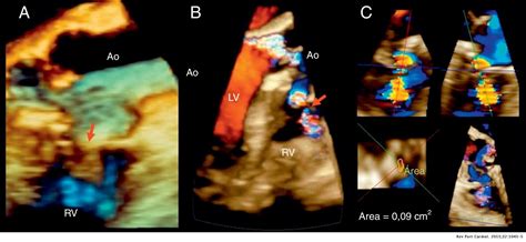 Echocardiographic diagnosis of ruptured right sinus of Valsalva ...