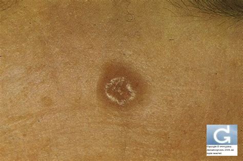 Basal Cell Carcinoma Forehead