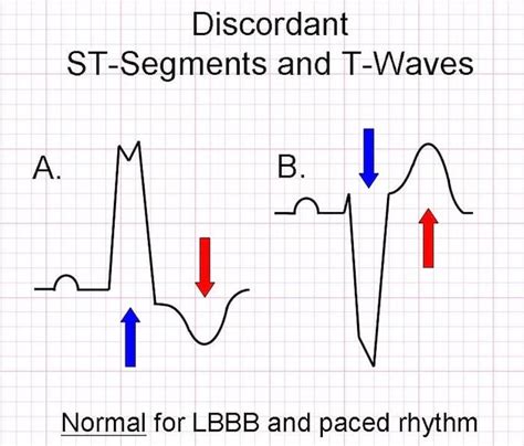 Sgarbossa Criteria • LITFL • ECG Library Diagnosis