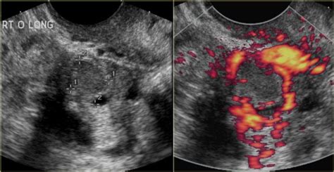 Hemorrhagic Corpus Luteum Ultrasound