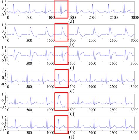 Six categories of ECG signals collected with the experimental platform.... | Download Scientific ...