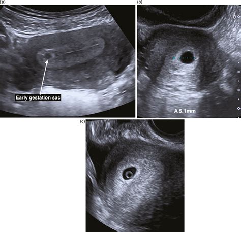 Ectopic Pregnancy Ultrasound