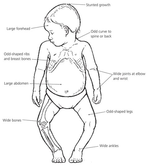 Ricket in children - Sign & Symptoms, Cause & Treatment – Trishla Ortho