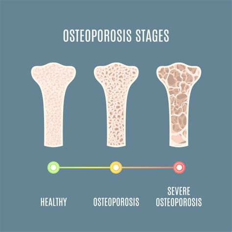 Osteoporosis Treatment In Mumbai - Dr. Saijyot Raut