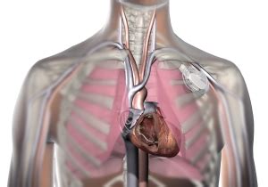 How are Pacemaker Leads Implanted? – Heart Rhythm Center