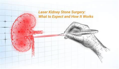 Laser Kidney Stone Surgery: What to Expect and How It Works