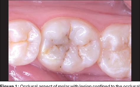 Figure 1 from Restoration of posterior teeth using occlusal matrix technique. | Semantic Scholar