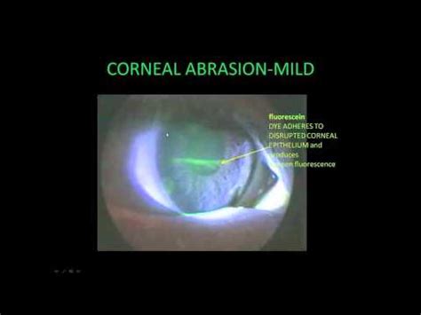 Ophthalmology Red Flag - Corneal Abrasion - YouTube