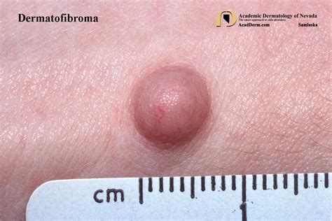 Dermatofibroma: Benign Fibrous Histiocytoma... - Academic Dermatology of Nevada