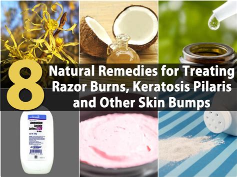 8 Natural Remedies for Treating Razor Burns, Keratosis Pilaris and ...