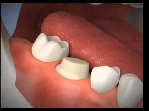 Porcelain Crown Procedure - YouTube