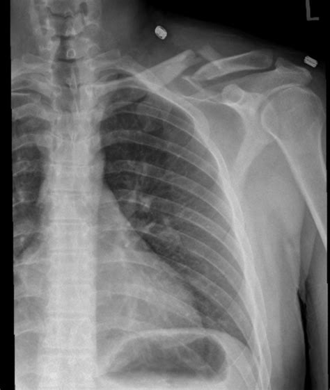 Clavicle Fracture – Undergraduate Diagnostic Imaging Fundamentals