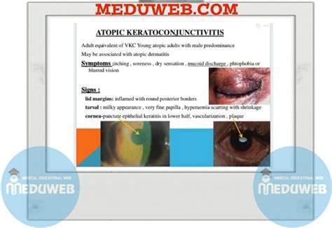 Atopic keratoconjunctivitis diagnosis and treatment - Meduweb