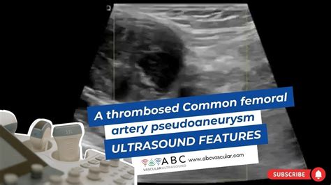 A Thrombosed Common Femoral Artery Pseudoaneurysm: Ultrasound Features - ABC Vascular