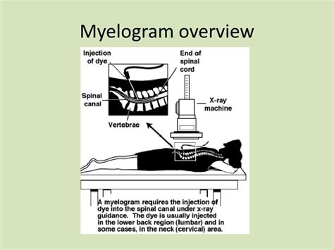 PPT - MYELOGRAPHY and CNS Exams using MRI & CT PowerPoint Presentation - ID:240432