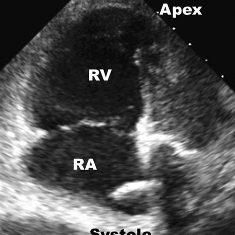 Echocargiographic still of McConnell's sign: RV akinesis with sparing... | Download Scientific ...