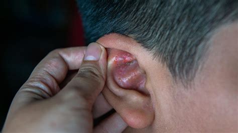 Ear Eczema: Symptoms, Causes, and Treatments