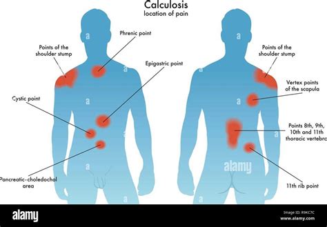 Mapping the Location of Kidney Pain: A Diagram