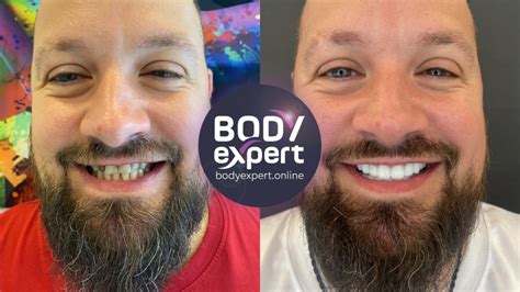 Dental implants: before - after, results after placement | Body Expert