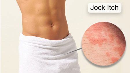 Home Remedies for Jock Itch – Entirely Health