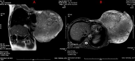 Phyllodes Tumor Growth Rate