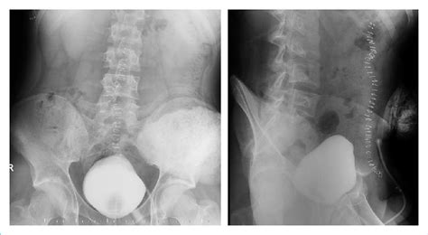 Retrograde cystography demonstrating normal integrity of the urinary ...