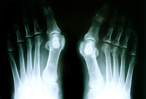 Looking for Minimally Invasive Bunion Surgery in Perth?