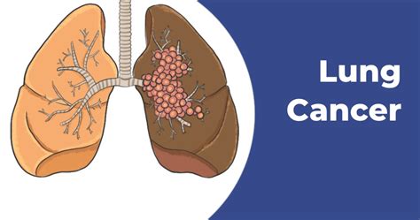 Lung Cancer Symptoms - Causes, Diagnosis & Treatment | Max Lab